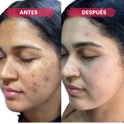 Anua - Sérum Eliminador Manchas y Marcas de Acné (30ml)
