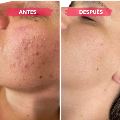 Anua - Sérum Eliminador Manchas y Marcas de Acné (30ml)