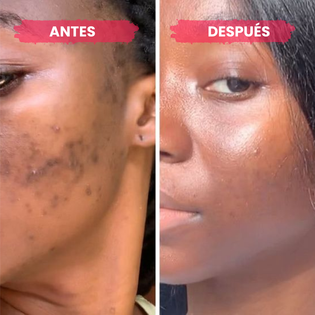 Anua - Sérum Eliminador Manchas y Marcas de Acné (30ml)